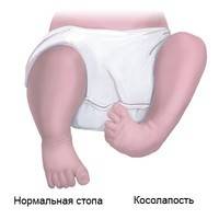 Косолапость у малышей 2